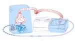 Illustration of a CPAP machine setup with mask, hose, humidifier, and blue airflow depicting usage.